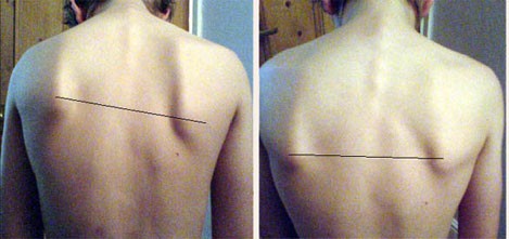 Photo of before and after Quantum Touch on shoulder blades
