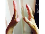 Healing Arthritis - the left hand is straightened out after 10 mins of Quantum Touch