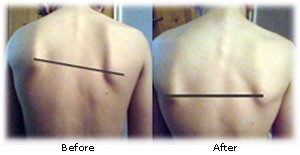 Photo of before and after Quantum Touch on shoulder blades